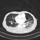 Loculated pleural fluid, aneurysm of left ventricle, apical and thrombosed, pneumothorax: CT - Computed tomography